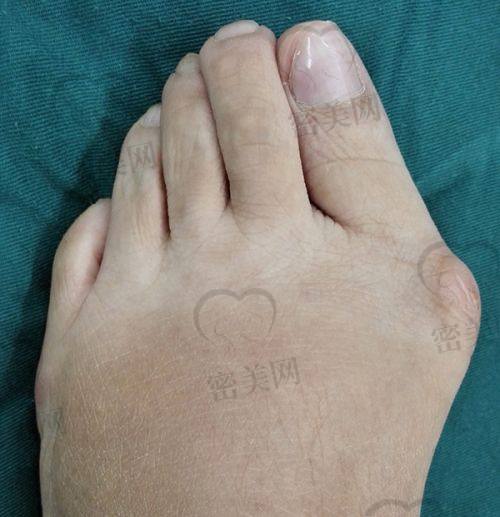 姚义超医生技术特点：