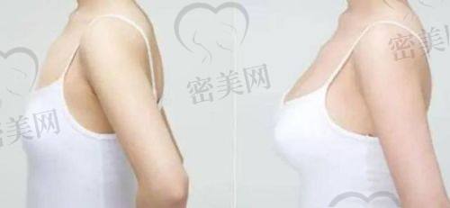 北京米兰柏羽丽都整形医院胡彬：傲诺拉假体隆胸的口碑大揭秘