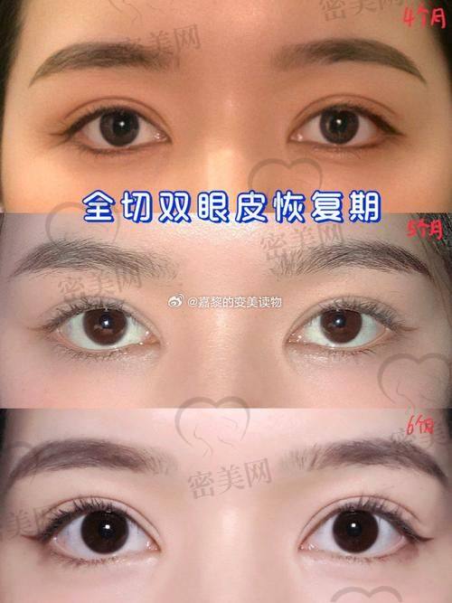 北京米兰柏羽丽都整形医院金鑫鑫埋线双眼皮：优势特色大放送