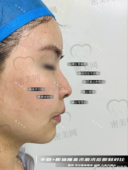 吴玉家医生在上海做塌鼻梁手术靠谱吗？技术实力揭秘
