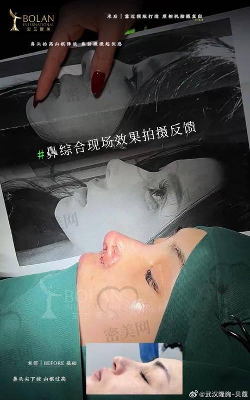上海塌鼻梁鼻综合技术对比一览（吴玉家 vs 普通医生）