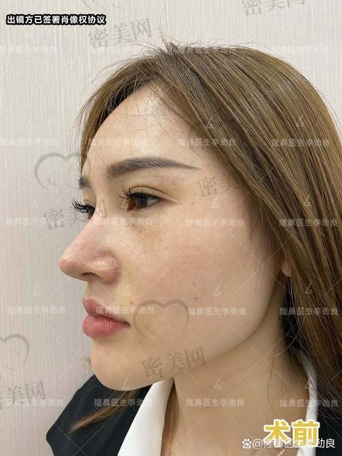 北京米兰柏羽丽都整形医院胡彬鼻综合：真人实例太惊艳！