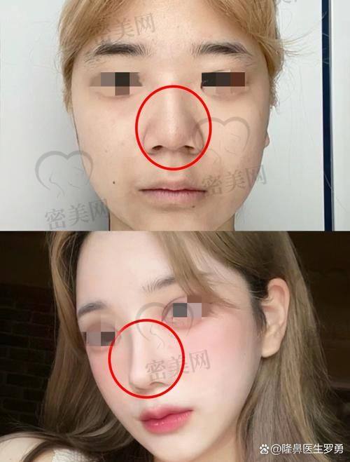 北京米兰柏羽丽都整形医院胡彬初鼻项目，口碑爆棚！