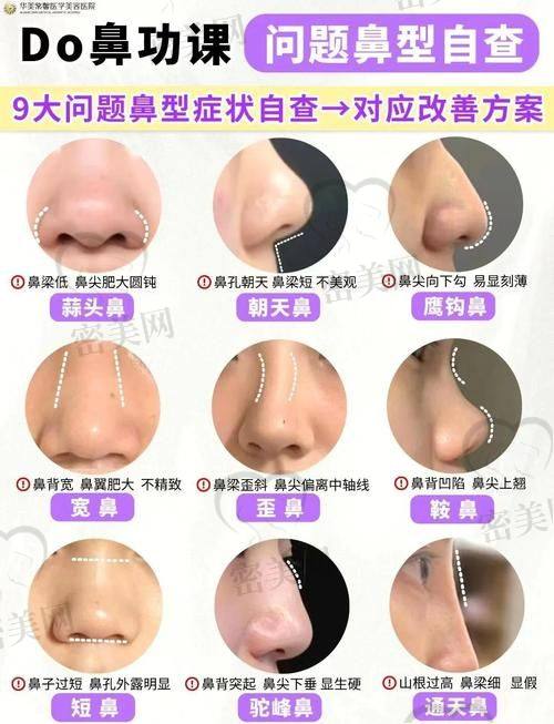 北京米兰柏羽丽都整形医院胡彬初鼻项目，真人实例超惊艳！