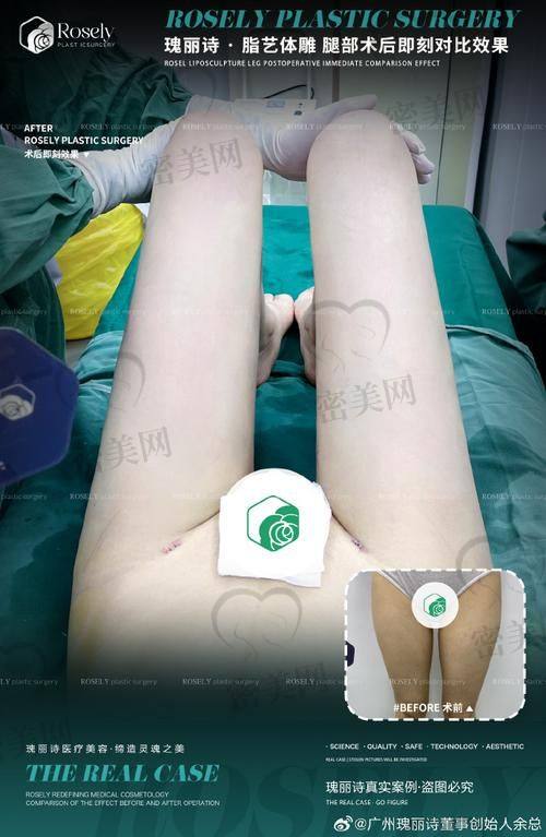 北京米兰柏羽丽都整形医院高海燕：大腿环吸的技术魔法