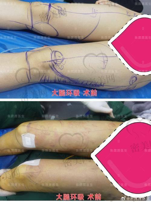 北京米兰柏羽丽都整形医院高海燕：大腿环吸的口碑传奇