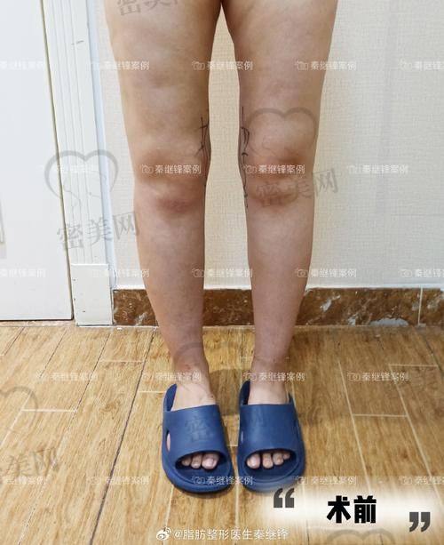 北京米兰柏羽丽都整形医院：大腿环吸的理想之选