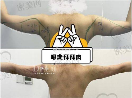 北京米兰柏羽丽都整形医院：小部位吸脂的理想之选