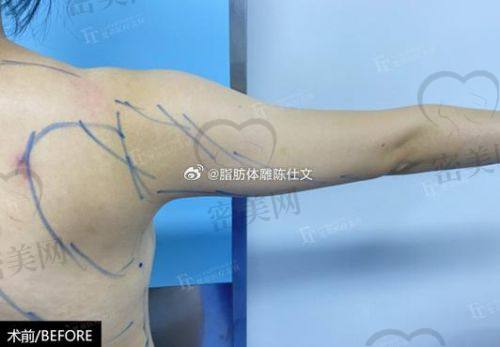 北京米兰柏羽丽都整形医院高海燕小部位吸脂：优势大揭秘