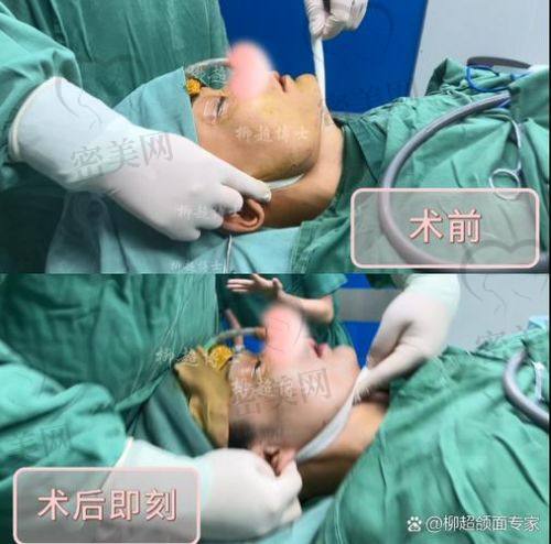 北京华韩吴国平：45°劈外板技术优势大揭秘