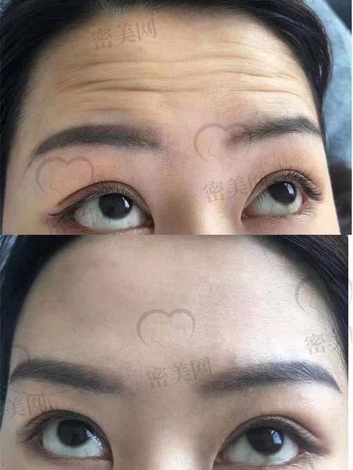 去抬头纹后的成效和感受，惊喜满满