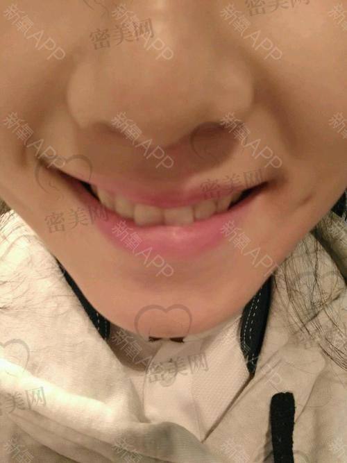 总结：填充垫下巴真香