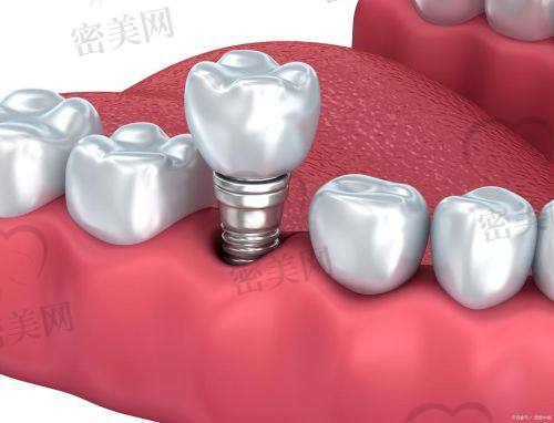 种植牙系统是真的便宜还是“打价格战”？揭秘它为什么这么便宜