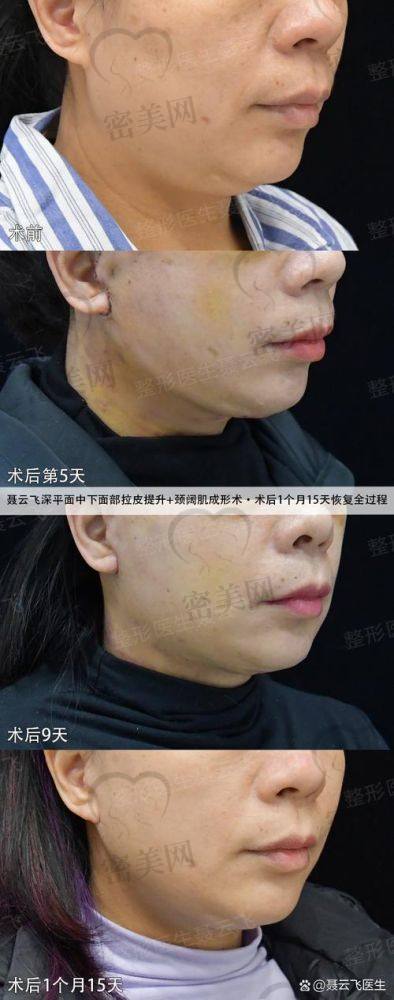 袁强：拉皮界的“潜力股”
