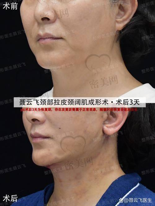 穆宝安和袁强拉皮谁更胜一筹？