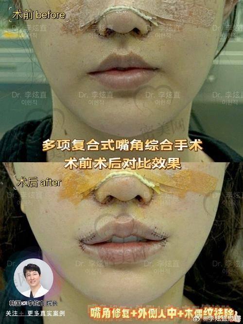 叶宇医生操作唇整形安心吗？术后会肿或者留疤吗？
