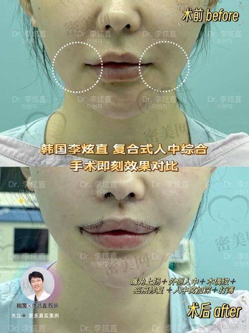 做唇部整形大概多少钱？叶宇医生收费标准揭秘