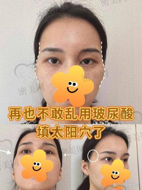 总结：玻尿酸填充太阳穴的那些事儿