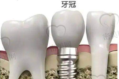 泰康拜博口腔2025年种植牙价格全解读