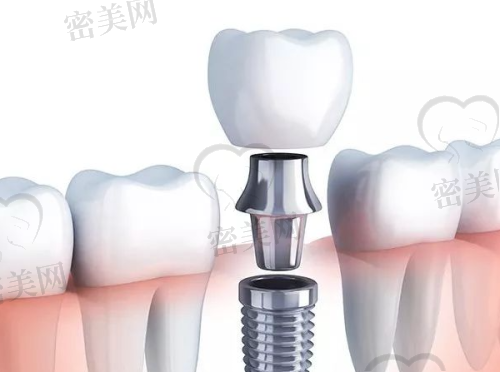 拔牙项目全攻略，分情况报价更合理