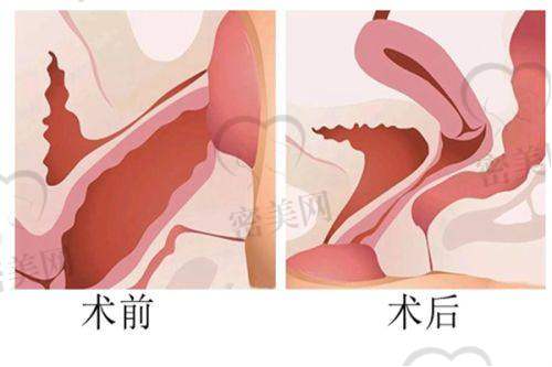 李智明医生技术特点：
