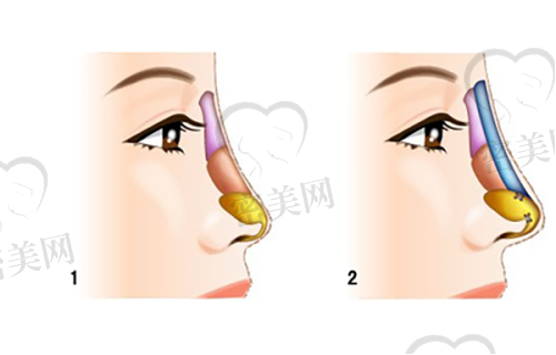 消除法令纹神器推荐