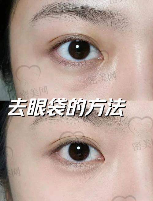 北京华韩整形医院谢立宁：S.O.F.T去眼袋的真人实例