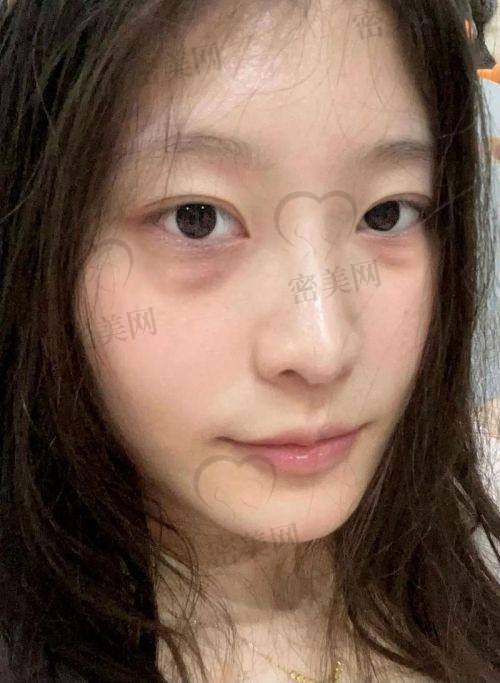 北京华韩整形医院谢立宁：S.O.F.T去眼袋的口碑评价
