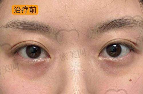 北京华韩整形医院谢立宁：S.O.F.T去眼袋的技术优势