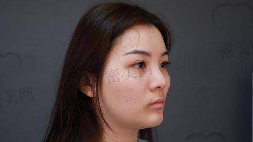 真人实例：谢立宁鼻综合的神奇成效