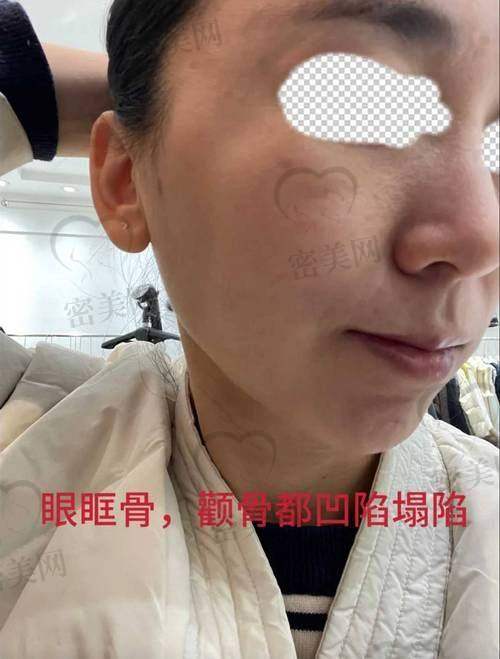 北京华韩吴国平颧骨内推：口碑爆棚的秘密