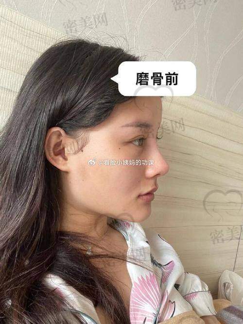 真人实例：北京华韩吴国平颧骨内推的神奇成效