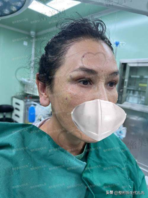 北京米兰柏羽丽都整形医院高海燕全方面部脂肪填充的优势特色