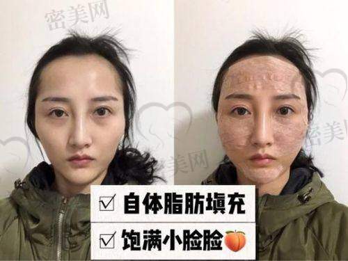 北京米兰柏羽丽都整形医院高海燕全方面部脂肪填充的口碑评价