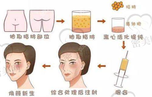北京米兰柏羽丽都整形医院高海燕全方面部脂肪填充真人实例