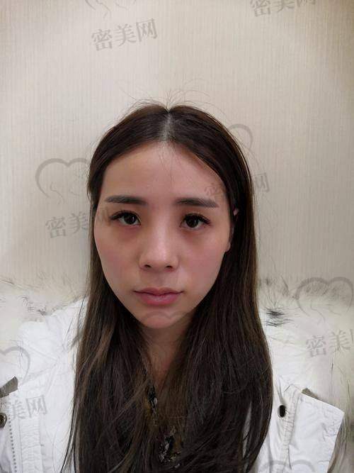 北京米兰柏羽丽都整形医院高海燕：真人实例见证神奇成效