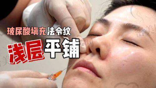 不同医院的法令纹填充价格差异