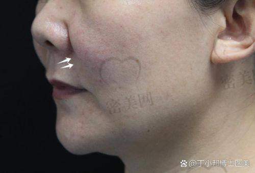 法令纹填充后咋护理？