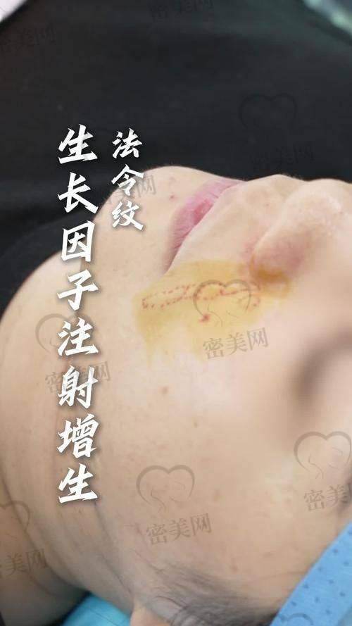 法令纹填充多少钱一针？
