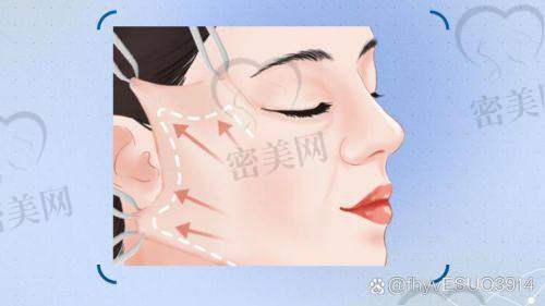 穆宝安拉皮成效到底如何？技术优势大揭秘