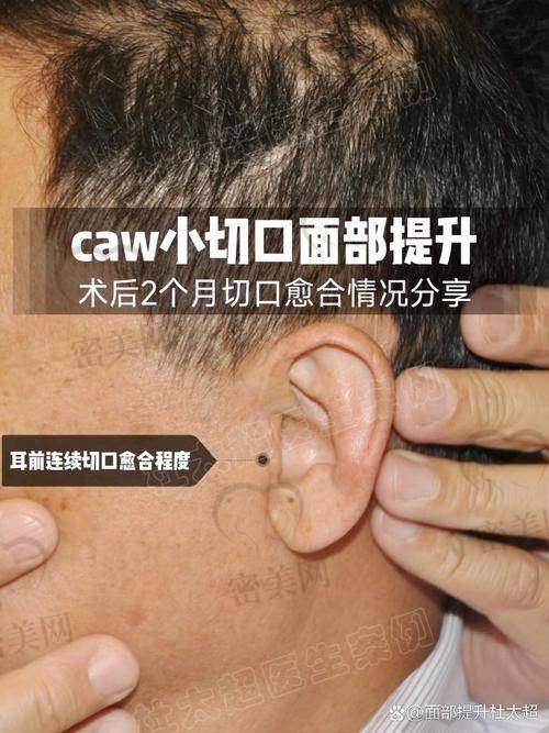 穆宝安面部提升技术优势大揭秘