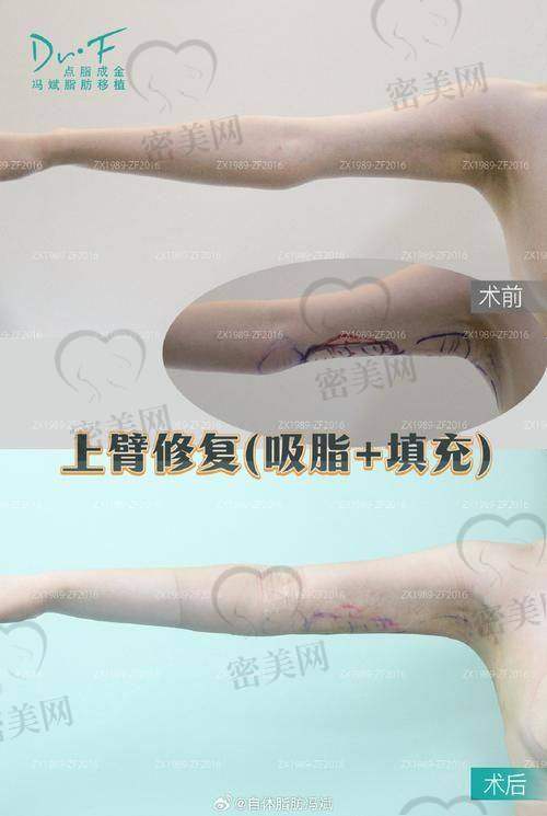 手术进行时，紧张又期待