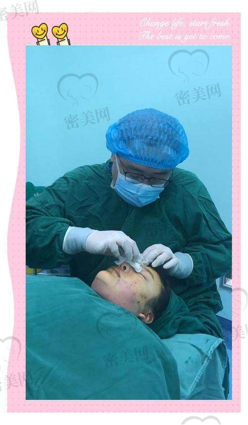 王东医生面部吸脂术后成效惊艳