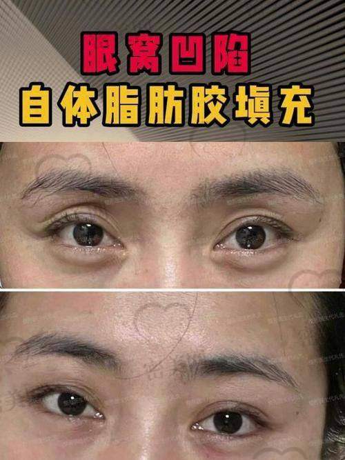 填充脂肪能维持多久?