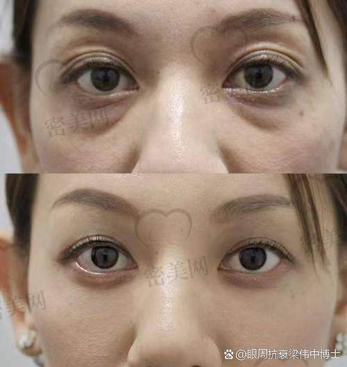 眼窝凹陷填充的修复方法