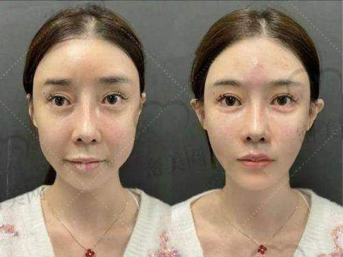 修复双眼皮成效:“失败眼”重焕光彩!