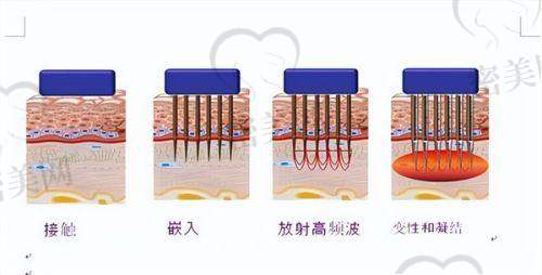 昆明黄金微针医院推荐表