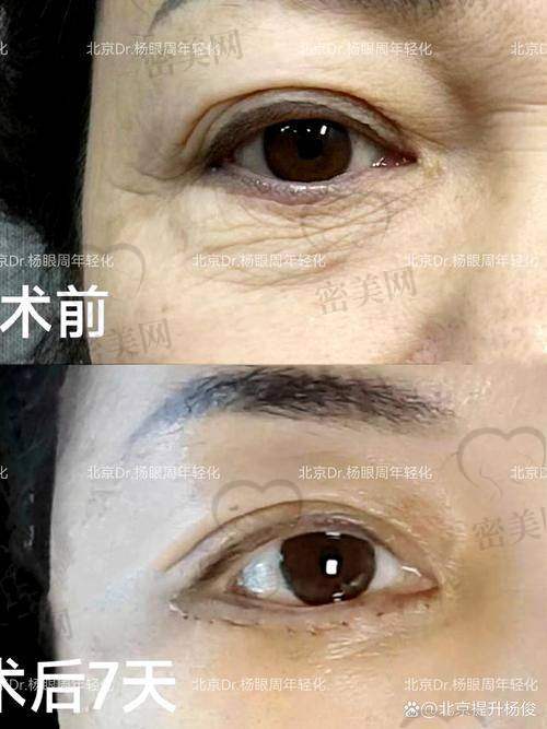 佀同帅医生简介：专注眼整形，主打项目显微双眼皮