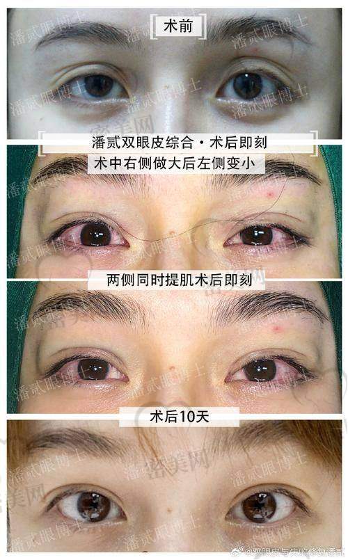 对比传统术式，显微sayoc双眼皮的优势