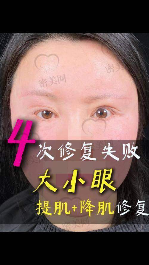 佀同帅双眼皮避雷是假的，收费标准特别合理
